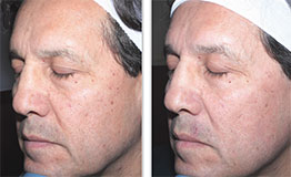 Before and after of a man's face from Sciton Halo treatment.