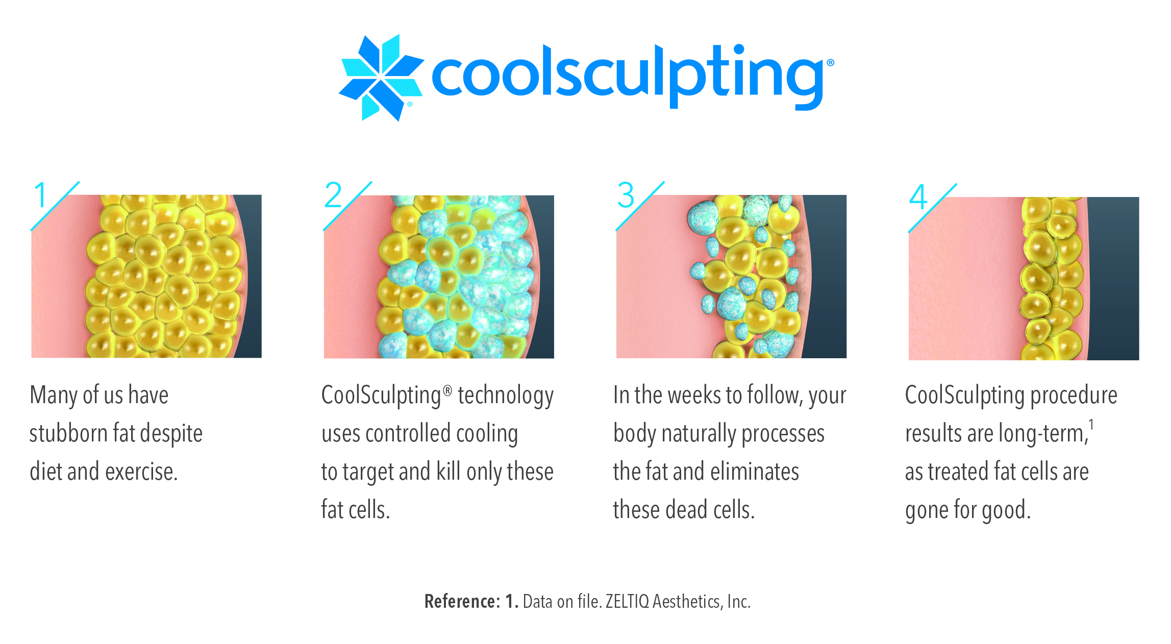 Coolsculpting diagram - how it works.