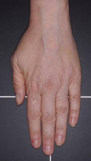 Hand Rejuvenation