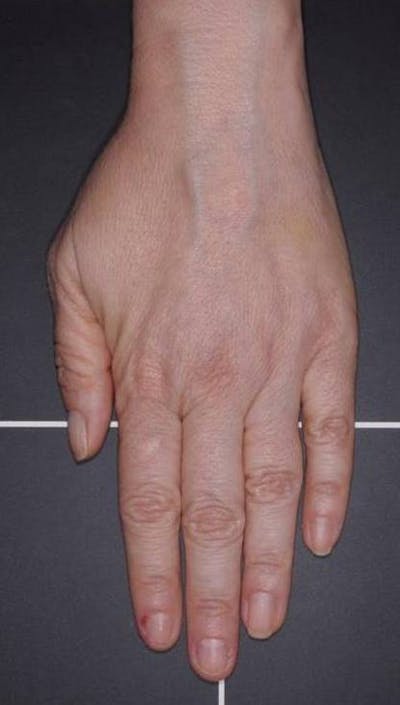 Fat Grafting for Hands Before & After Gallery - Patient 4513918 - Image 2