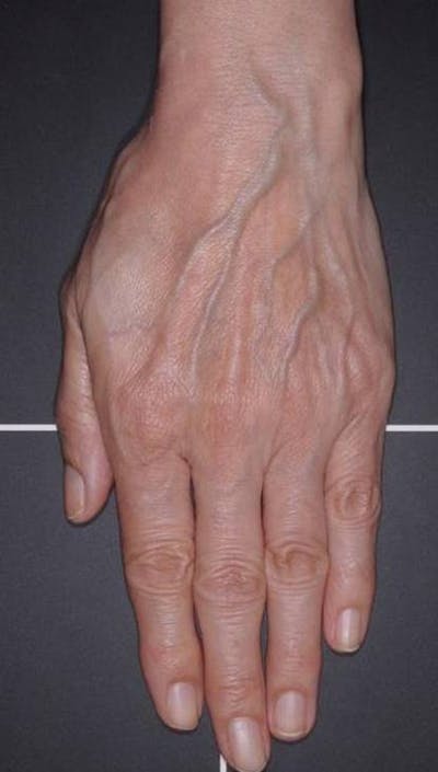 Fat Grafting for Hands Before & After Gallery - Patient 4513918 - Image 1