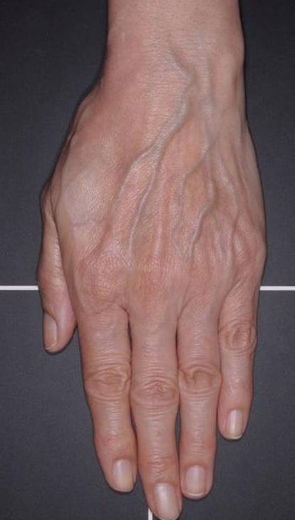 Fat Grafting for Hands Before & After Gallery - Patient 4513918 - Image 1