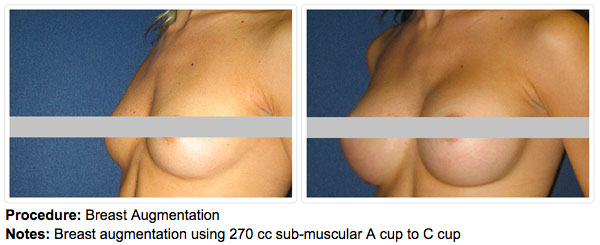 Before and After of a Breast Augmentation with Dr. Alizadeh