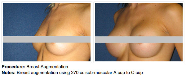 Before and After of a Breast Augmentation with Dr. Alizadeh