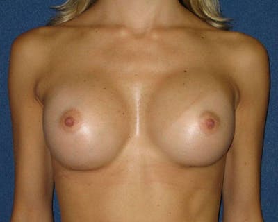 Breast Augmentation Before & After Gallery - Patient 4454965 - Image 2