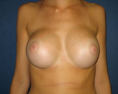 Breast Augmentation Before & After Gallery - Patient 4455015 - Image 2