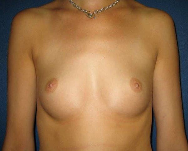 Breast Augmentation Before & After Gallery - Patient 4455015 - Image 1