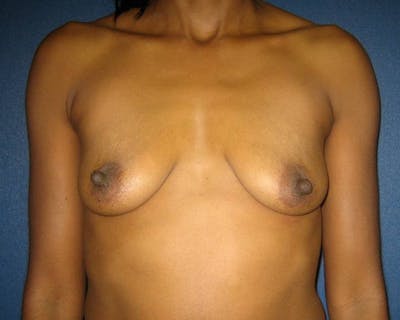 Breast Augmentation Gallery - Patient 4455138 - Image 1