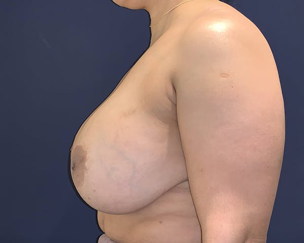Breast Lift with Fat Grafting Before & After Gallery - Patient 4488534 - Image 5