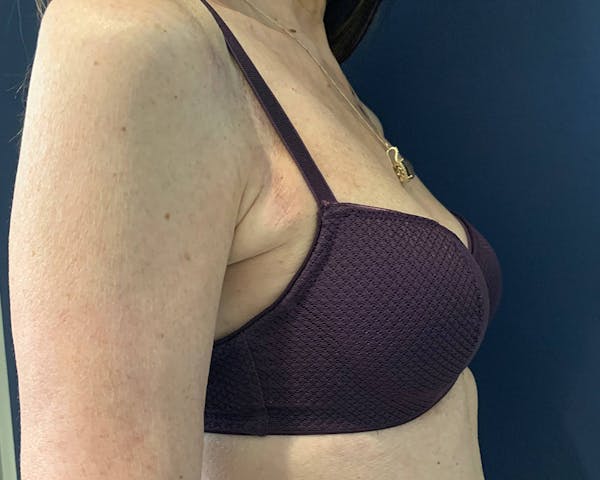 Skin Cancer or Tumor Removal Before & After Gallery - Patient 142025320 - Image 2