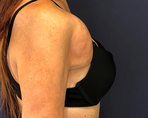 Breast Reconstruction Before & After Gallery - Patient 142812950 - Image 1