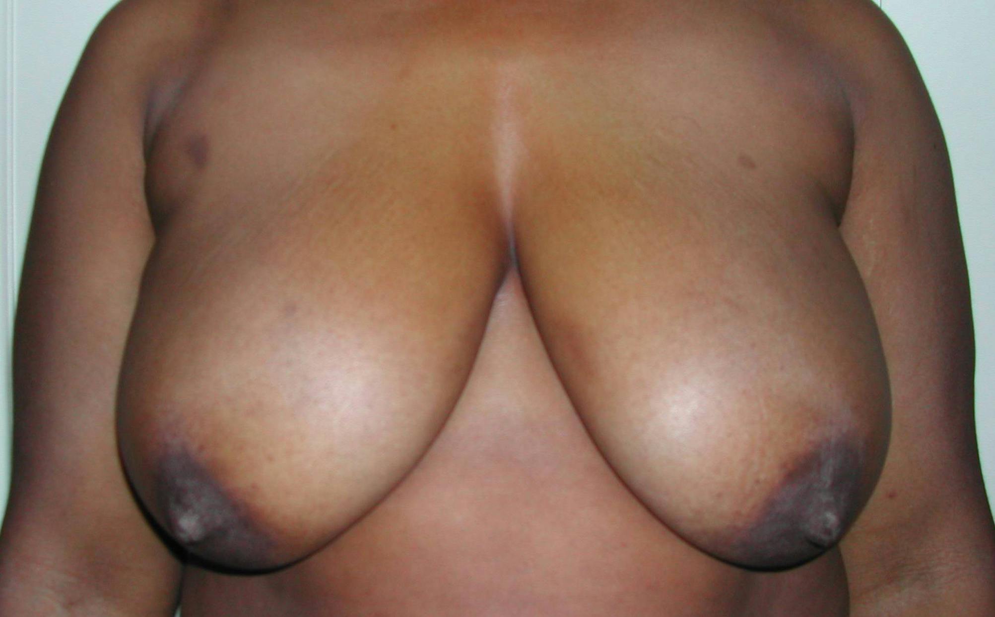 Breast Reduction Before & After Gallery - Patient 4488193 - Image 1