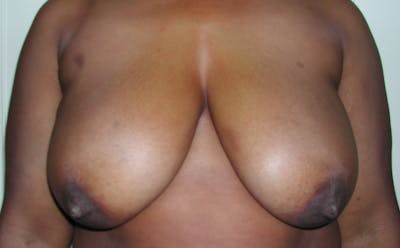 Breast Reduction Before & After Gallery - Patient 4488193 - Image 1