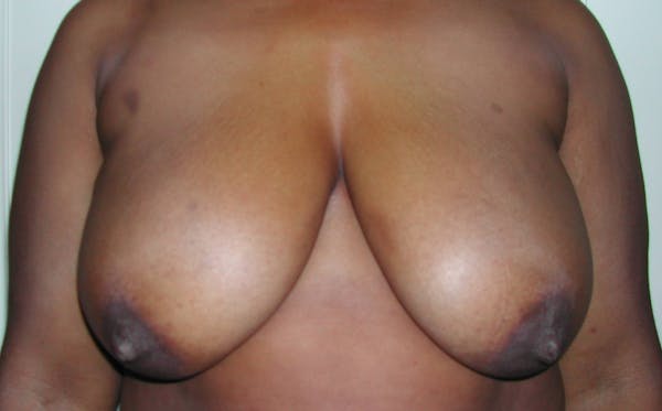 Breast Reduction Before & After Gallery - Patient 4488193 - Image 1