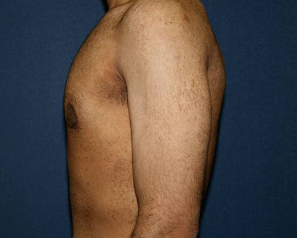 Gynecomastia (Male Breast Reduction) Before & After Gallery - Patient 4454712 - Image 4