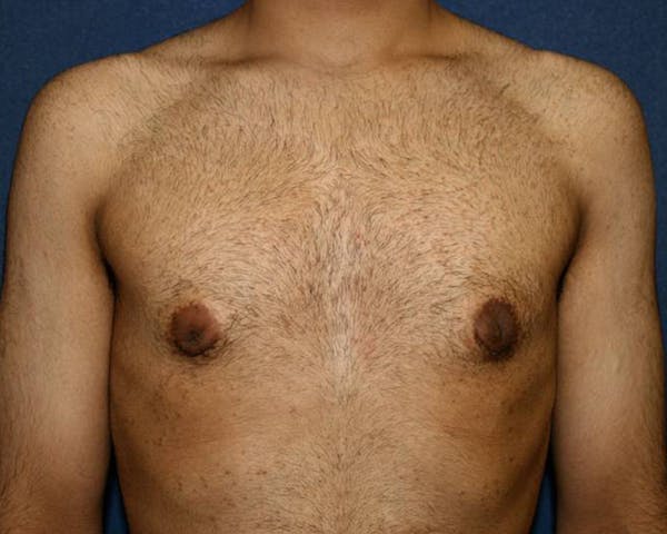 Gynecomastia (Male Breast Reduction) Before & After Gallery - Patient 4454712 - Image 2