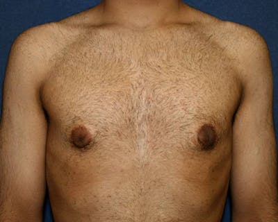Gynecomastia (Male Breast Reduction) Before & After Gallery - Patient 4454712 - Image 2