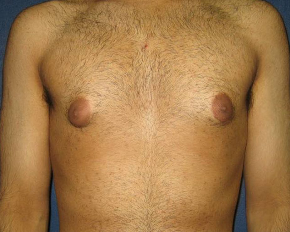 Gynecomastia (Male Breast Reduction) Gallery - Patient 4454712 - Image 1