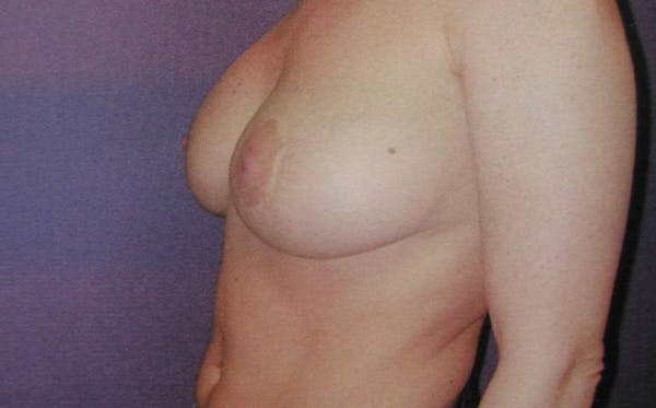 NaturaBra® Mastopexy Before & After Gallery - Patient 4488514 - Image 3
