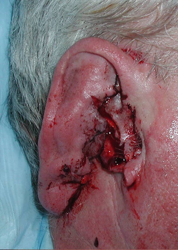 Ear Repair Before & After Gallery - Patient 4448187 - Image 1