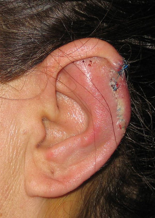Ear Repair Before & After Gallery - Patient 4448225 - Image 2