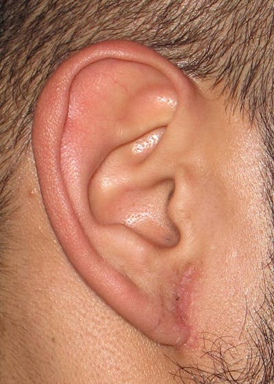 Ear Repair Before & After Gallery - Patient 4448264 - Image 4