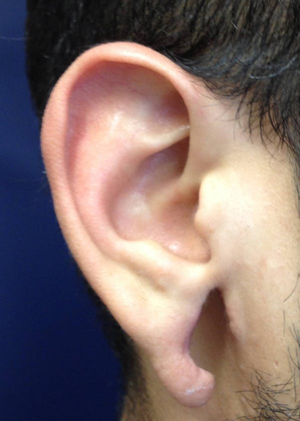 Ear Repair Before & After Gallery - Patient 4448264 - Image 3