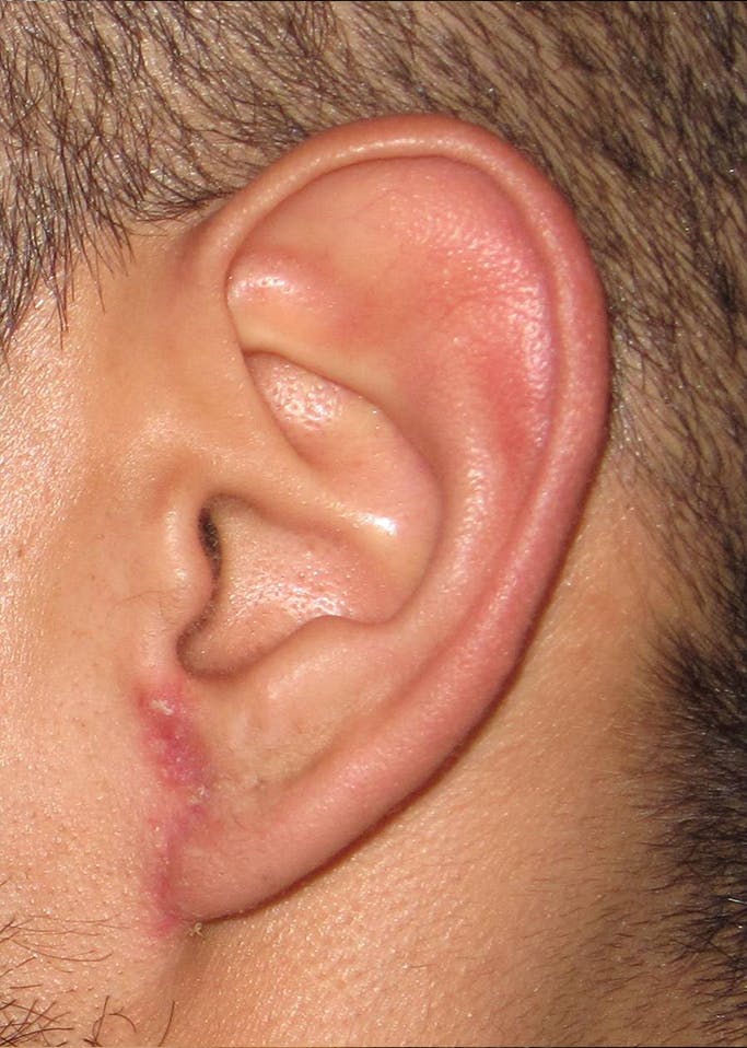 Ear Repair Before & After Gallery - Patient 4448264 - Image 2