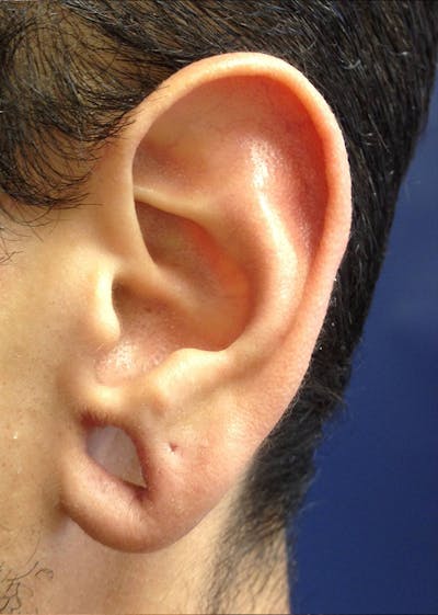 Ear Repair Before & After Gallery - Patient 4448264 - Image 1