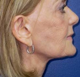 Neck Lift Before & After Gallery - Patient 141112680 - Image 2