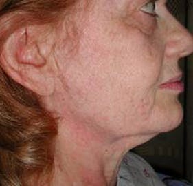 Facelift Before & After Gallery - Patient 4447225 - Image 1