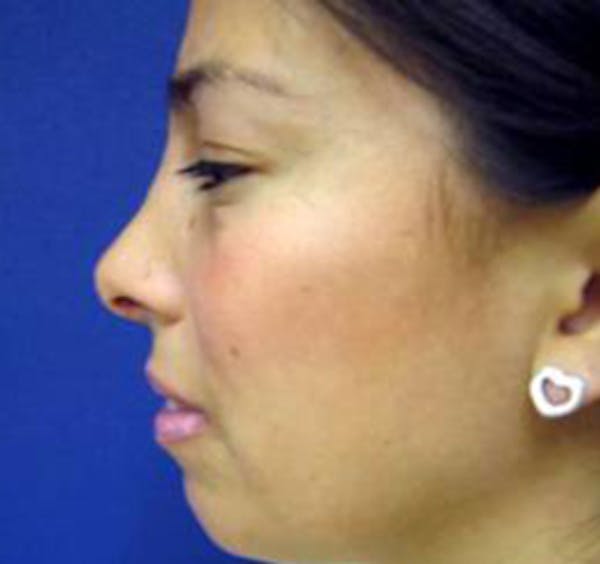 Rhinoplasty Before & After Gallery - Patient 4447364 - Image 4