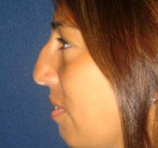 Rhinoplasty Before & After Gallery - Patient 4447364 - Image 3