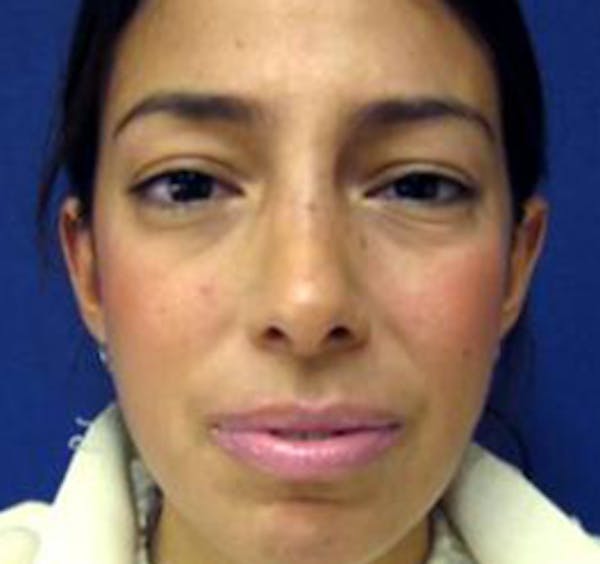 Rhinoplasty Before & After Gallery - Patient 4447364 - Image 2