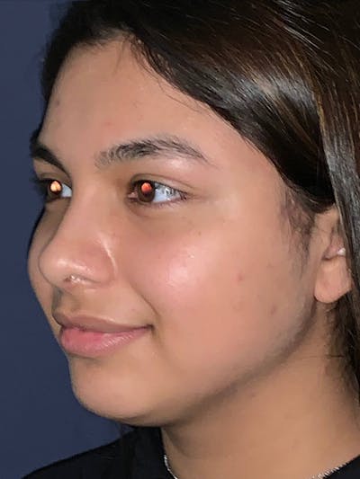 Rhinoplasty Before & After Gallery - Patient 4447369 - Image 6