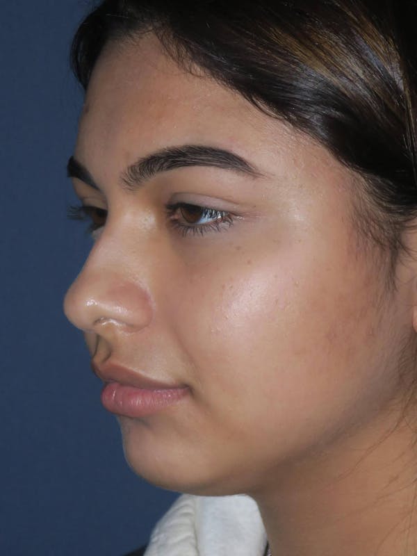 Rhinoplasty Before & After Gallery - Patient 4447369 - Image 5