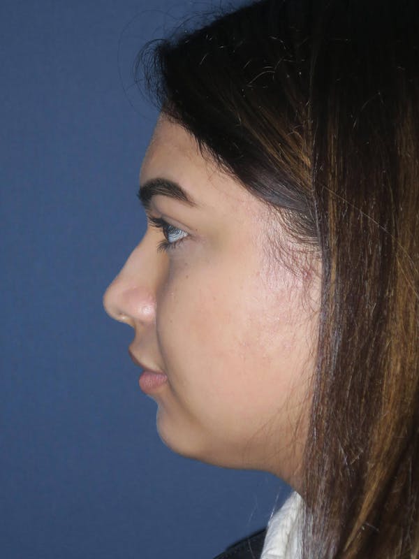 Rhinoplasty Before & After Gallery - Patient 4447369 - Image 3