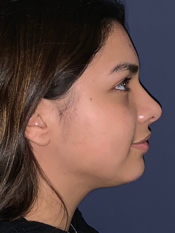 Rhinoplasty Before & After Gallery - Patient 4447369 - Image 8