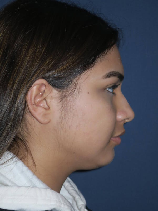 Rhinoplasty Before & After Gallery - Patient 4447369 - Image 7