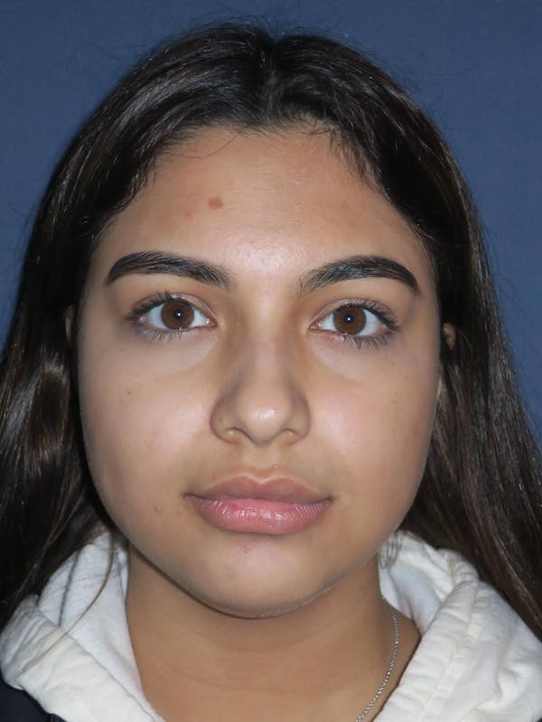 Rhinoplasty Before & After Gallery - Patient 4447369 - Image 1