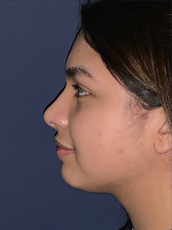Rhinoplasty Before & After Gallery - Patient 4447369 - Image 4