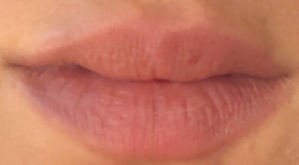 Lip Augmentation Before & After Gallery - Patient 4454372 - Image 1
