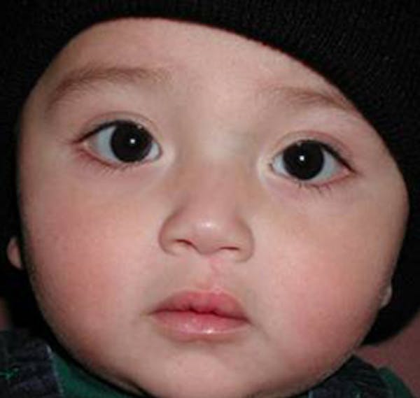 Cleft lip and nose repair Before & After Gallery - Patient 4488589 - Image 2