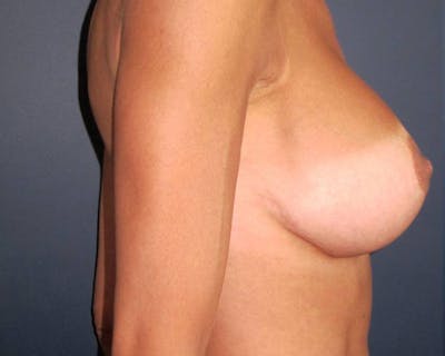Breast Reconstruction Before & After Gallery - Patient 142812963 - Image 4