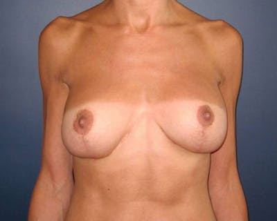 Breast Reconstruction Before & After Gallery - Patient 142812963 - Image 2