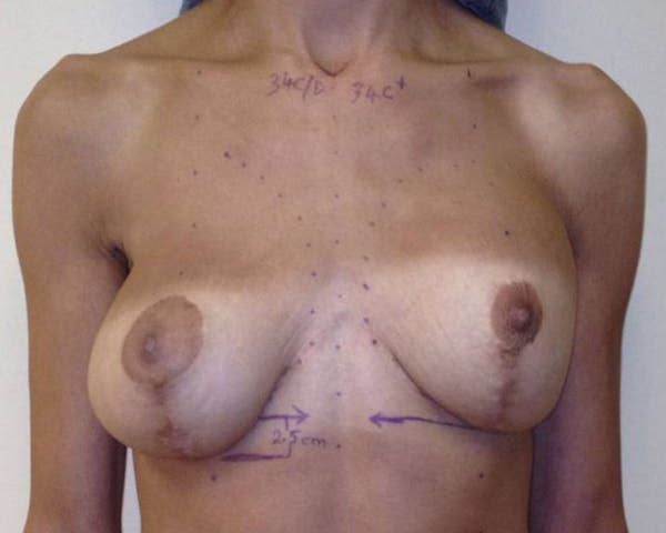 Breast Reconstruction Before & After Gallery - Patient 142812963 - Image 1