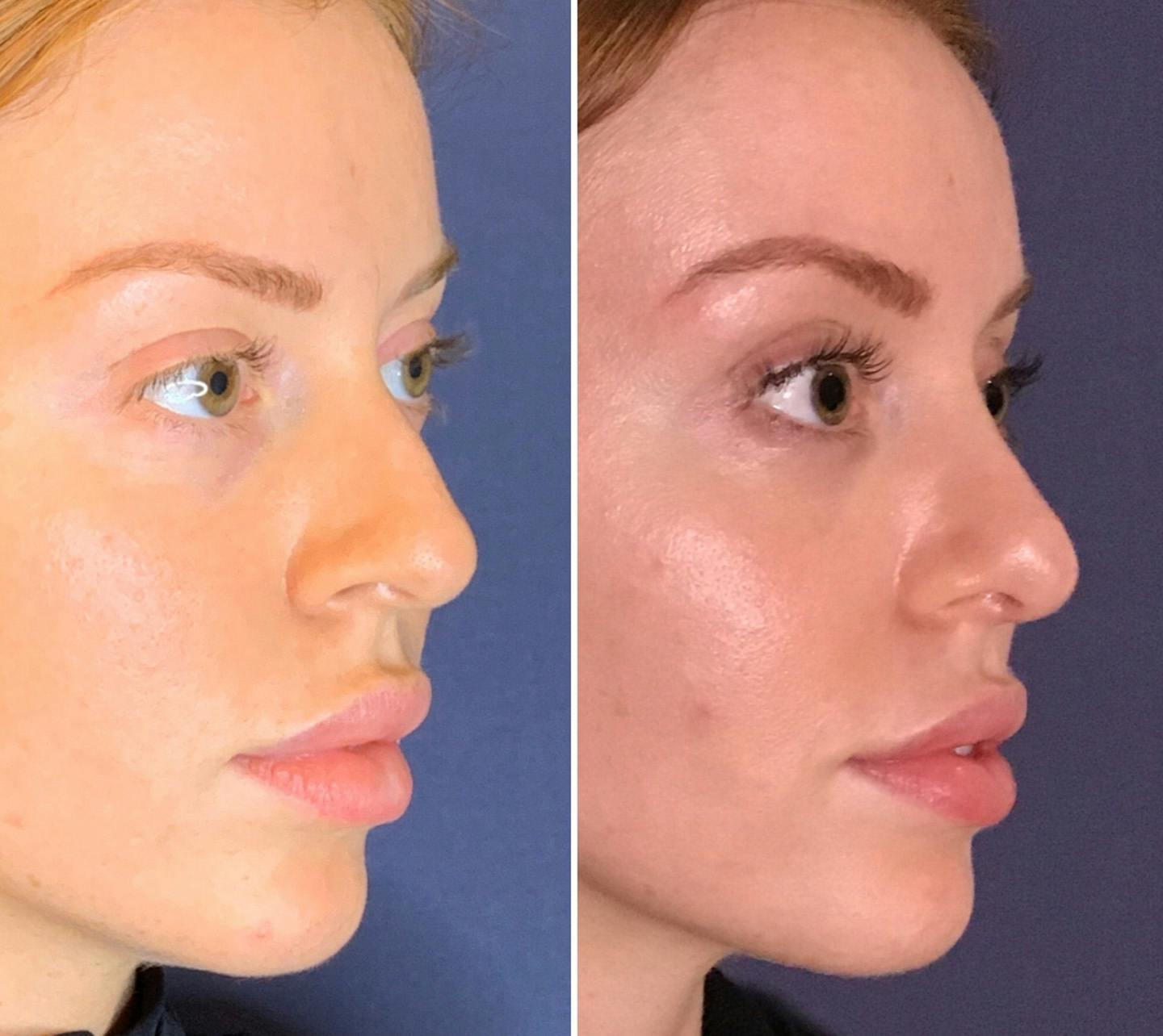 Before and after rhinoplasty with board-certified plastic surgeon Dr. Alizadeh.