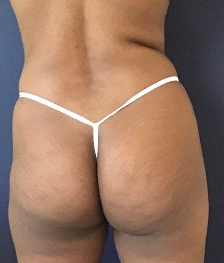 Brazilian Buttock Augmentation Before & After Gallery - Patient 13732967 - Image 1