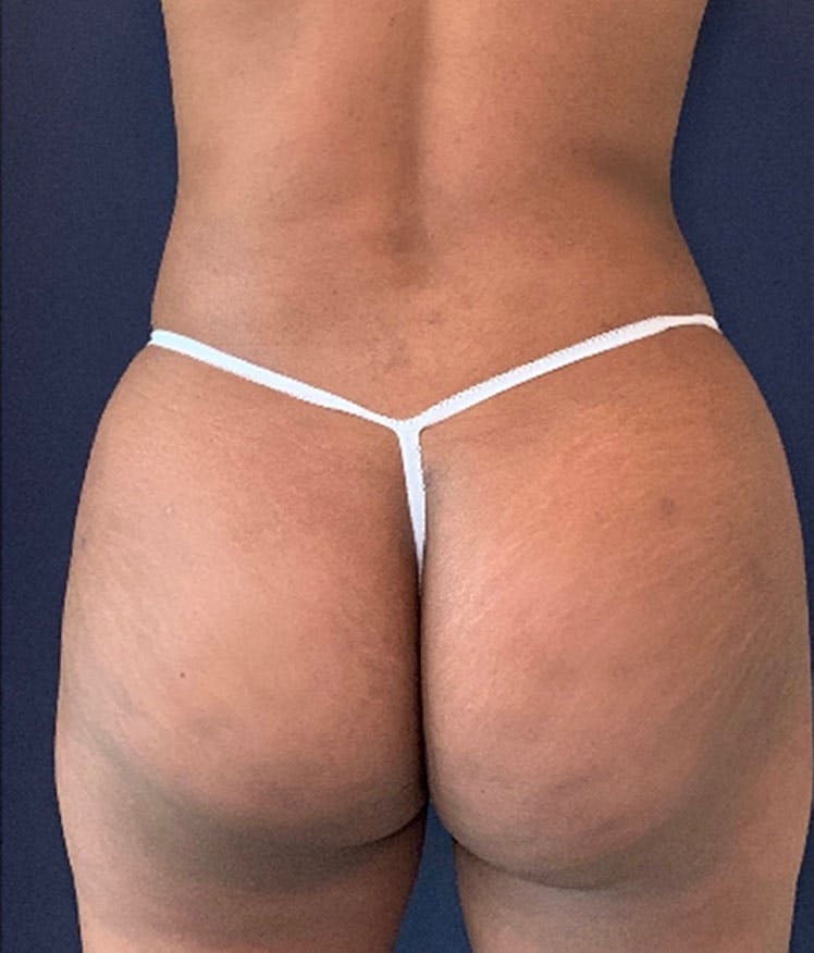 Brazilian Buttock Augmentation Before & After Gallery - Patient 13732967 - Image 2