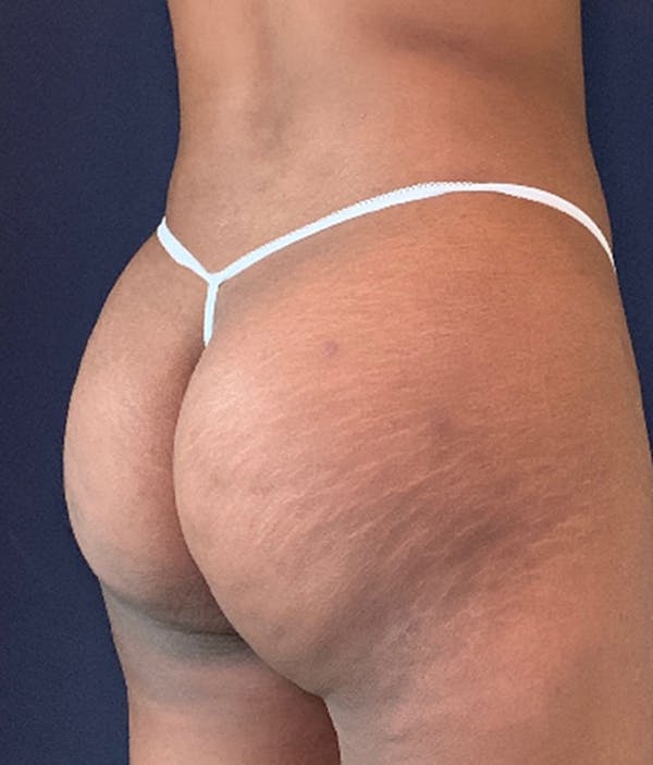 Brazilian Buttock Augmentation Before & After Gallery - Patient 13732967 - Image 4